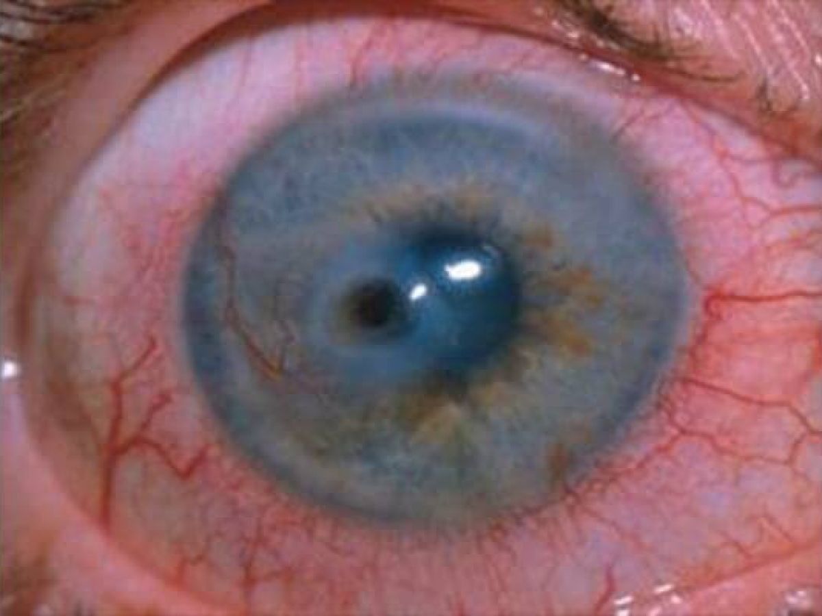 Diagnosis of Corneal Diseases