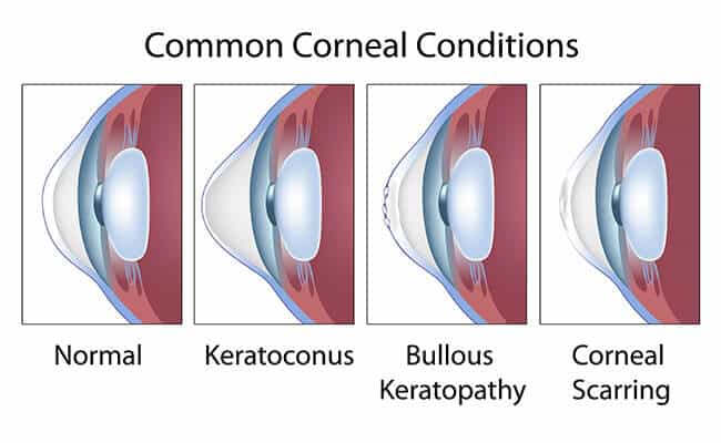 Types of Corneal Conditions