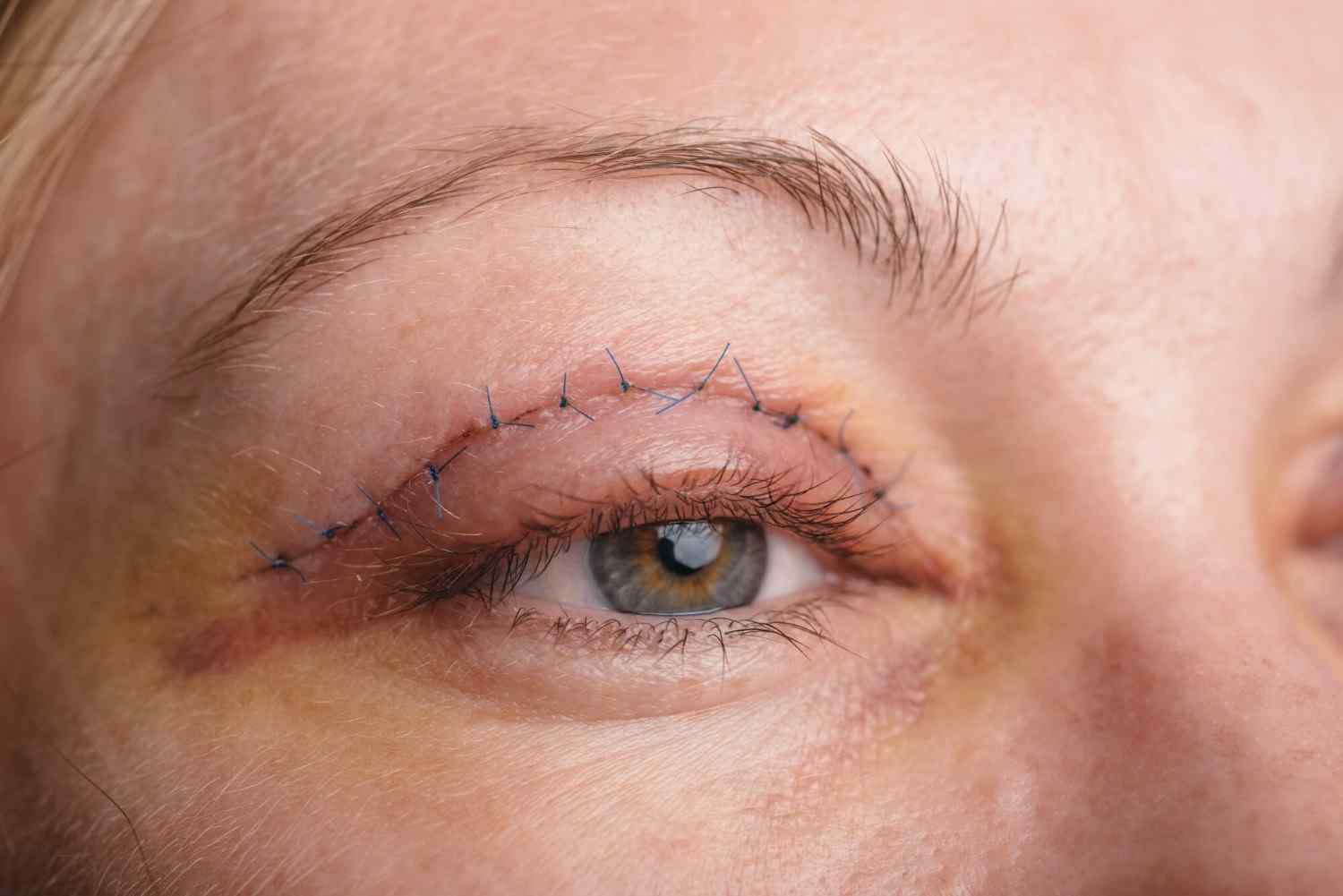 Oculoplasty Surgery Recovery