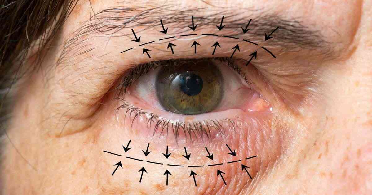 What is Oculoplasty Surgery