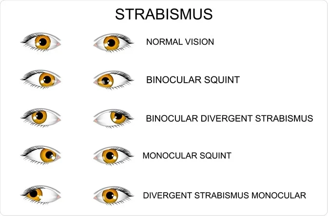 What is Squint (Strabismus)